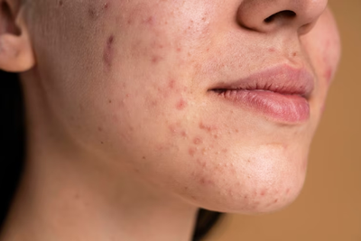 What Causes Open Pores